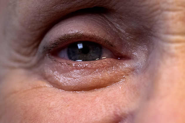 Ephiphora: What Causes Teary Eyes?